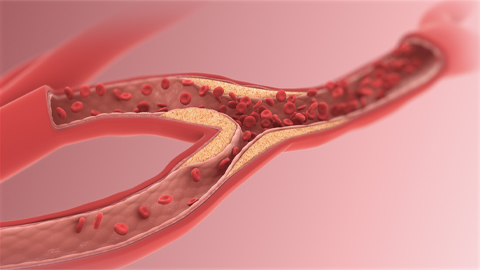 Analyzing triglycerides in Americans of African ancestry