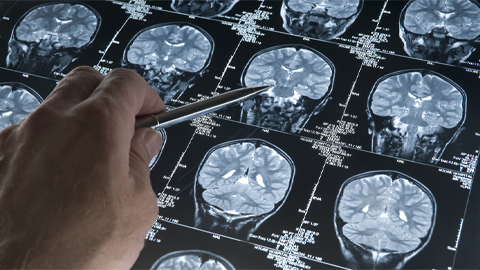 Mutant RNA exosome protein linked to neurodevelopmental defects
